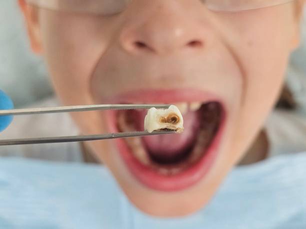 Best Emergency Wisdom Teeth Removal in Mikes, TX